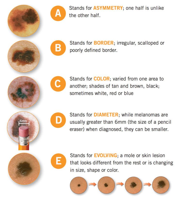 abcde_full - Dean Dermatology & Skin Therapy